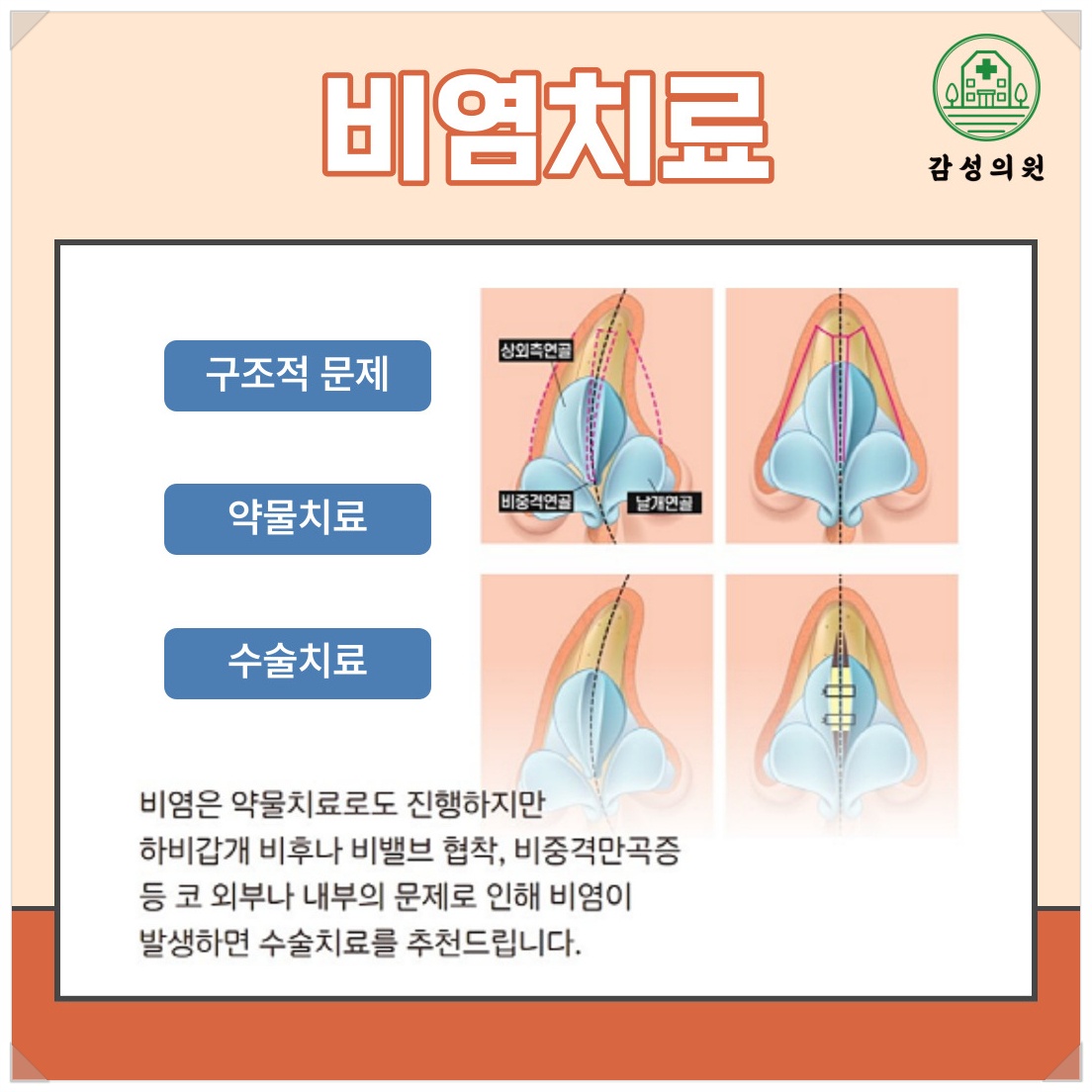 비염2.jpg