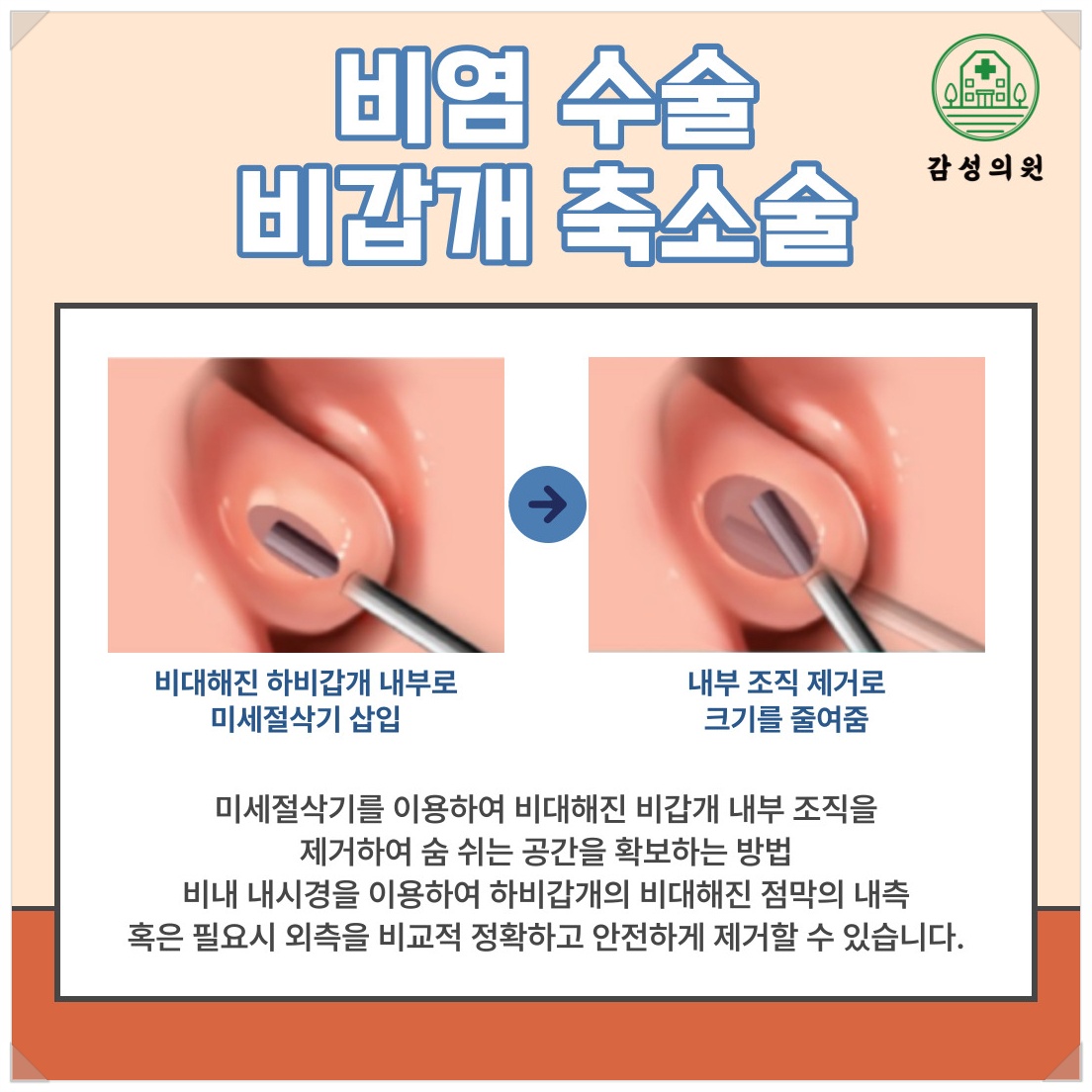비염5.jpg